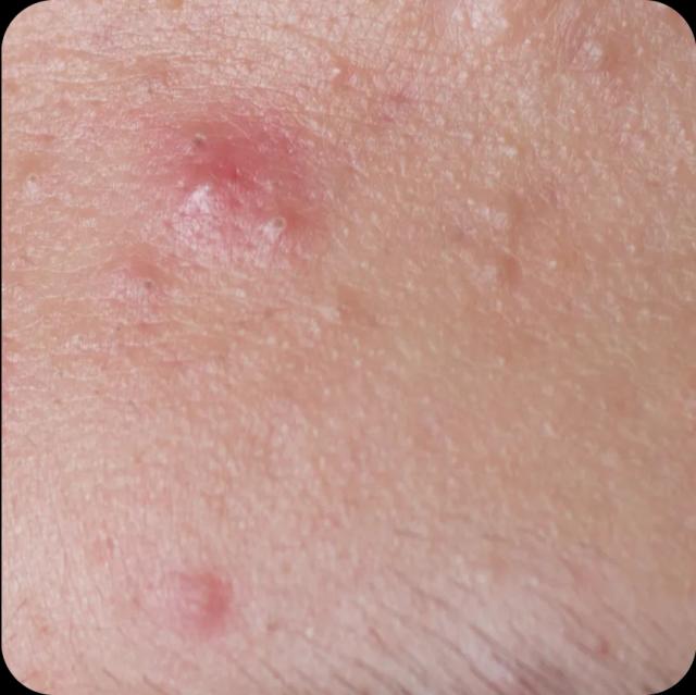 small_bumps