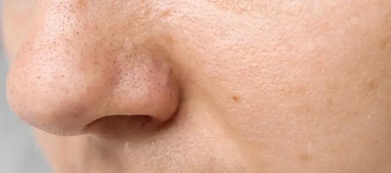 Causes of blackheads and medical advice