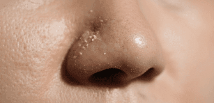 Whiteheads overview with treatment