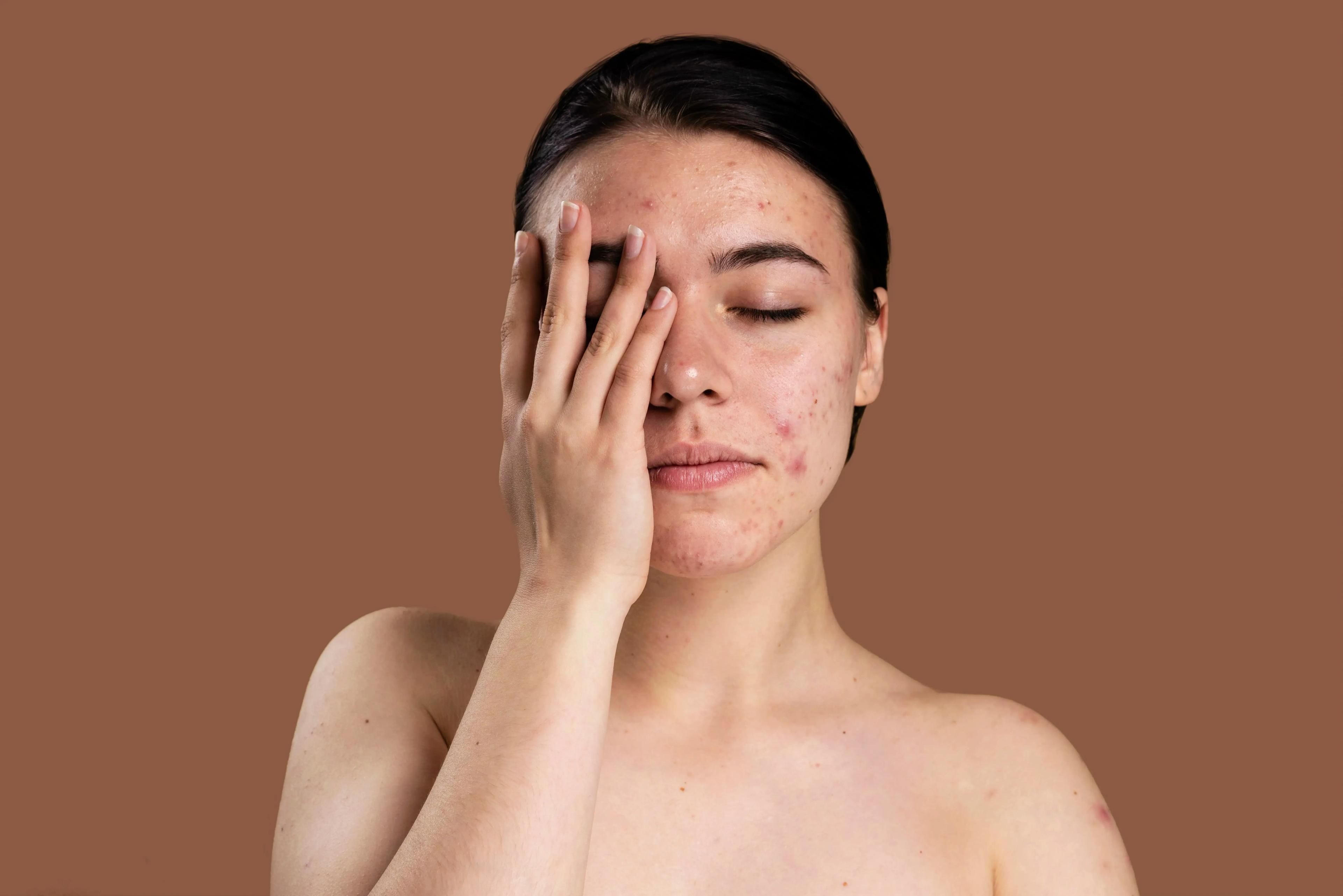 Comprehensive acne causes and triggers