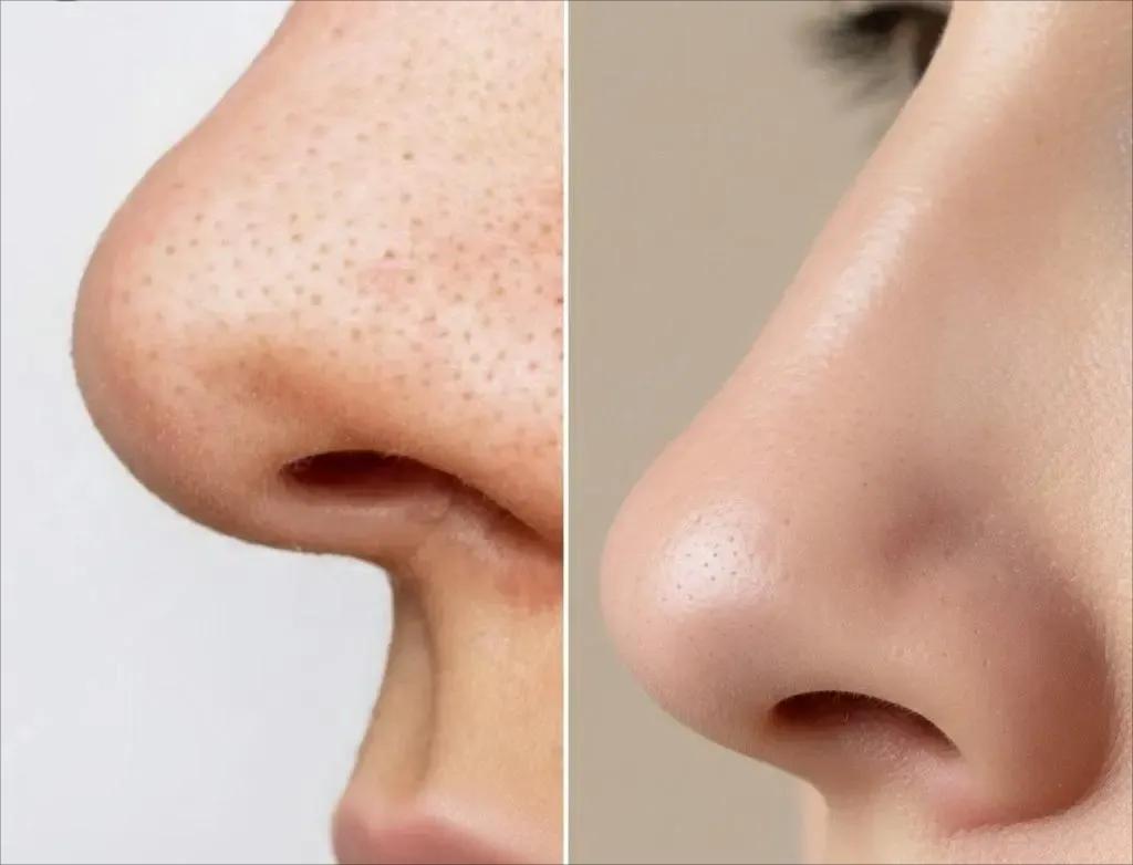 Difference between blackheads and sebaceous filaments