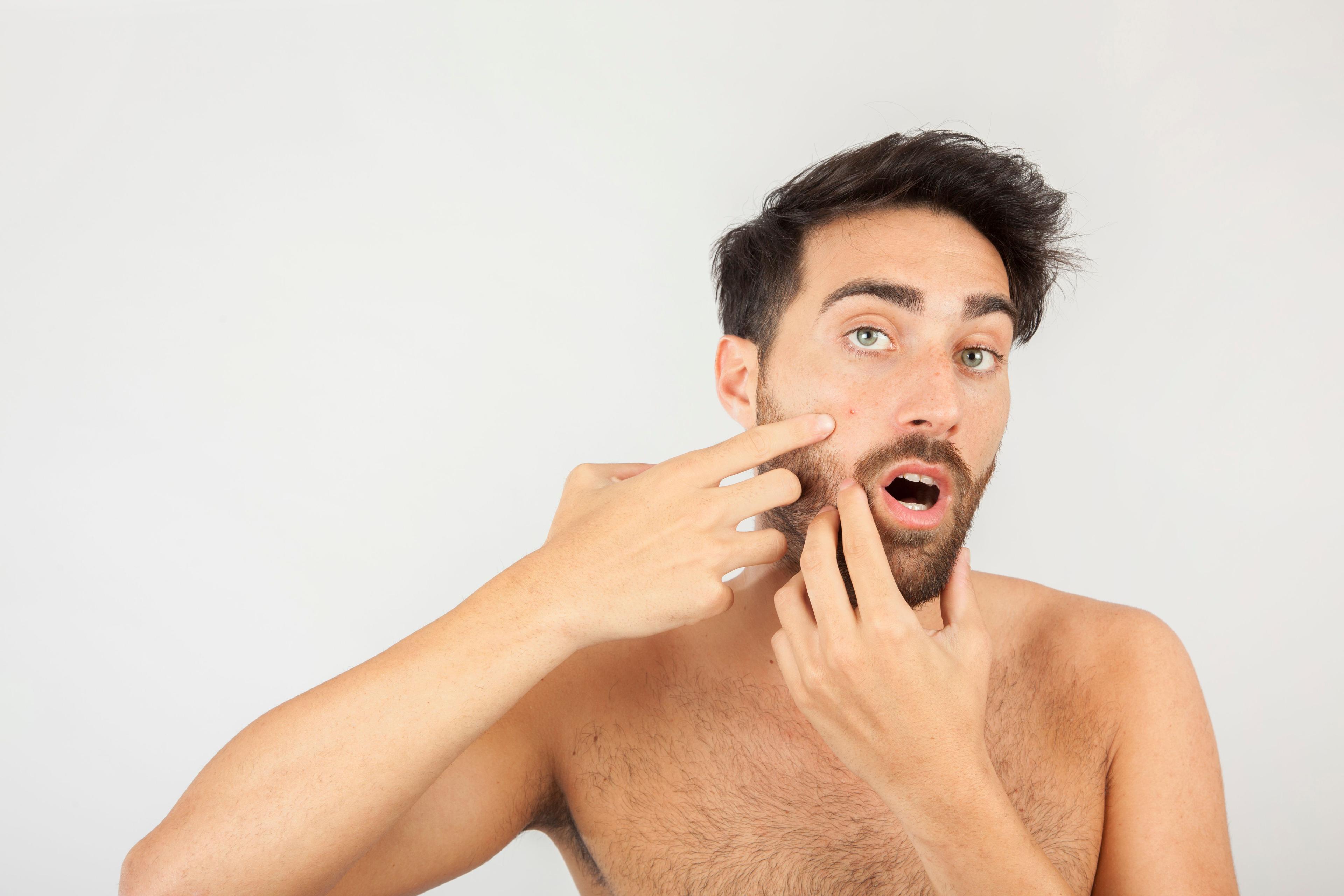 Sunscreen causing or preventing acne