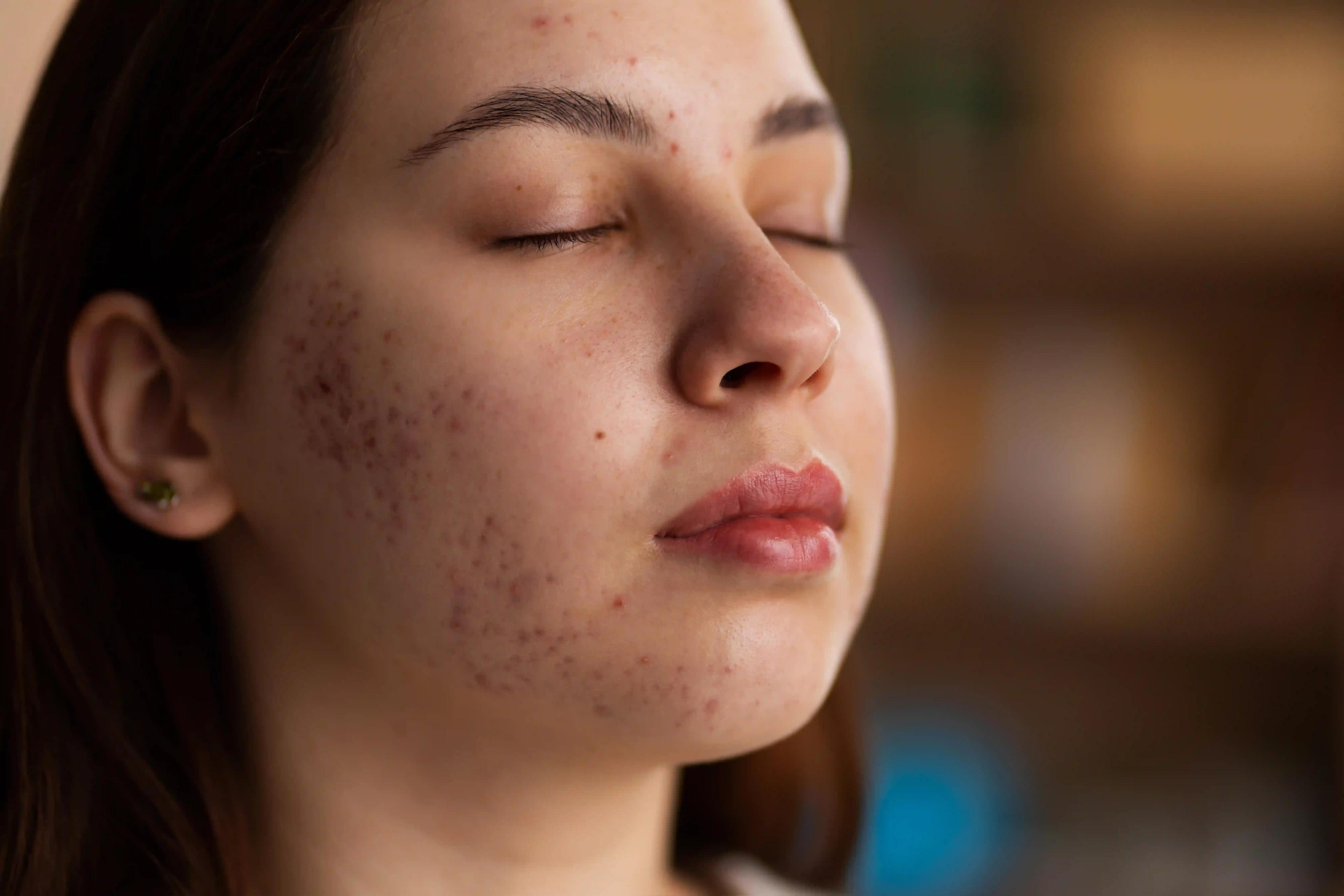 Comprehensive acne treatment options