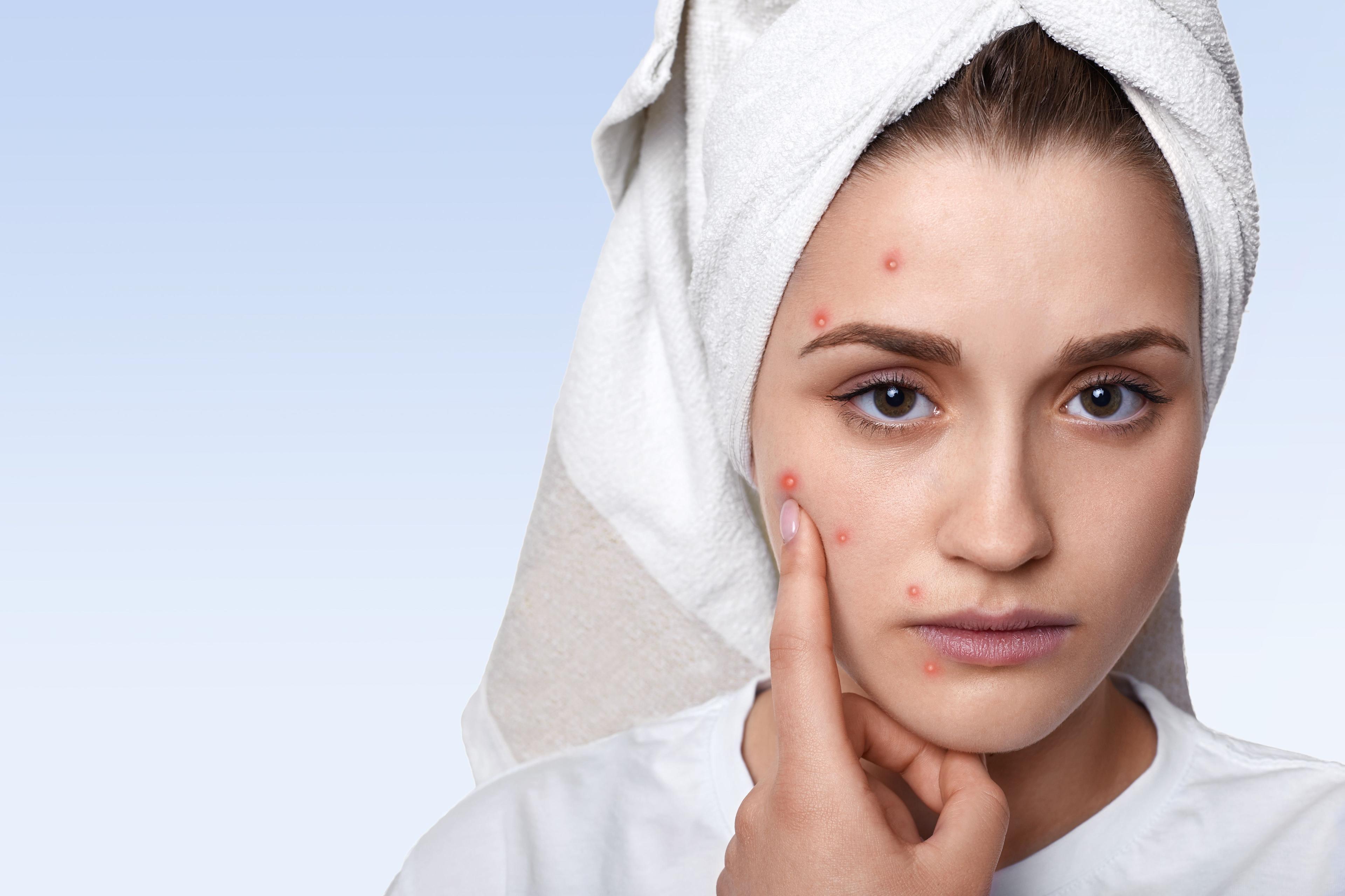 Healing timeline of a pimple