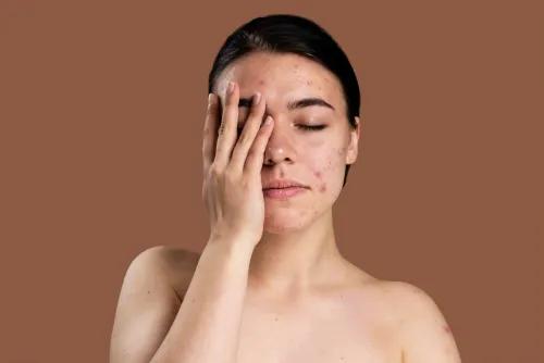 Everything You Need to Know About the Causes & Triggers of Acne