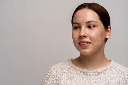 Acne Prone Skin: Complete Guide to Symptoms, Causes, Triggers and Long-Term Skin Management