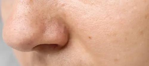 Blackheads: What Causes Them and When to See a Dermatologist