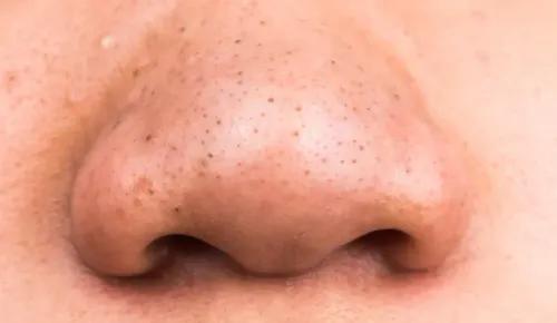 Blackheads in Indian Skin: Why They’re Common & How to Manage