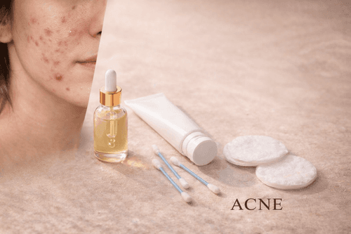 Acne Scars vs Post-Inflammatory Hyperpigmentation