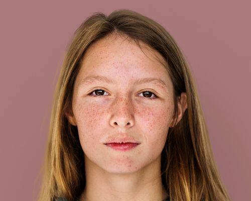 How to Treat Cystic Acne on Cheeks and Forehead Correctly?