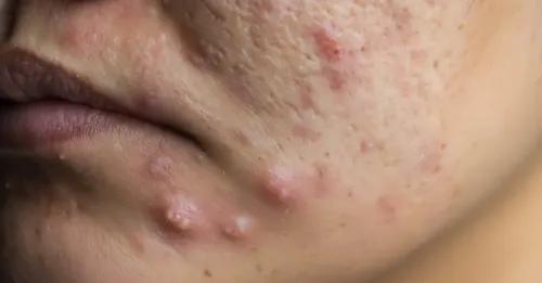 Nodules Acne: Understanding Causes, Symptoms, Treatments & Prevention