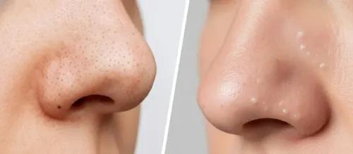 Whiteheads vs Blackheads: Key Differences & Treatment Guide