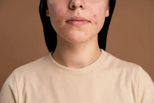 Hormonal Acne Explained: What Really Causes It and How to Manage It