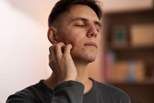 Itchy Acne: When It Could Be Fungal