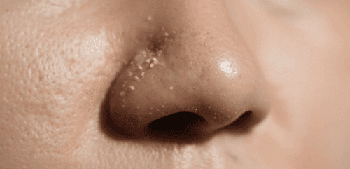 Whiteheads: Causes, Symptoms, Treatment & Prevention Guide